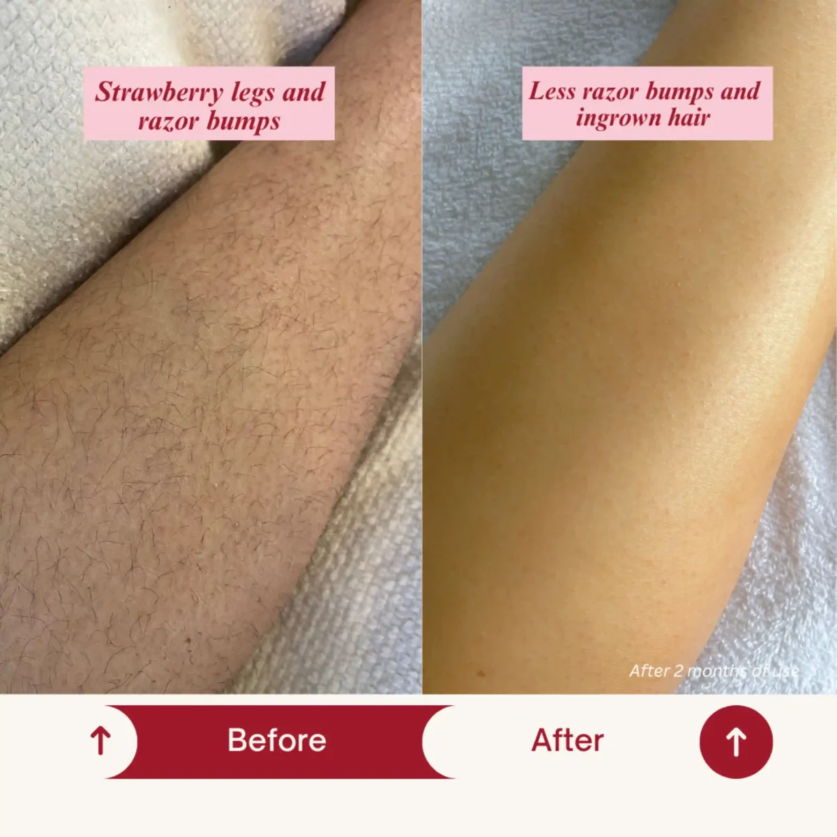 preventing strawberry legs,razor bumps after shaving