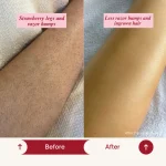 preventing strawberry legs,razor bumps after shaving