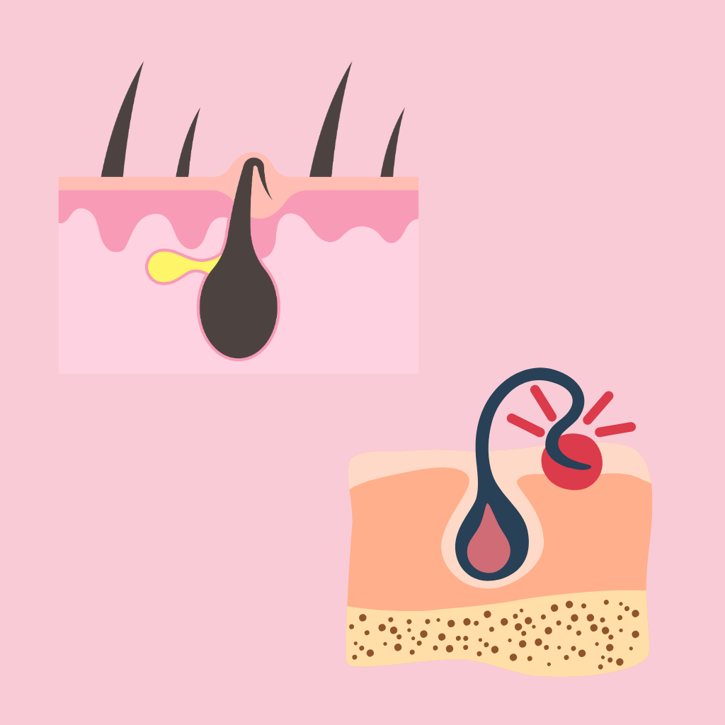 type of ingrown hairs