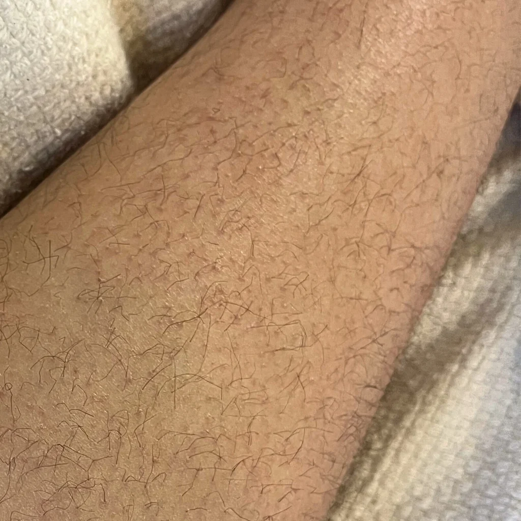 Preventing ingrown hair and razor bump. How to prevent strawberry legs