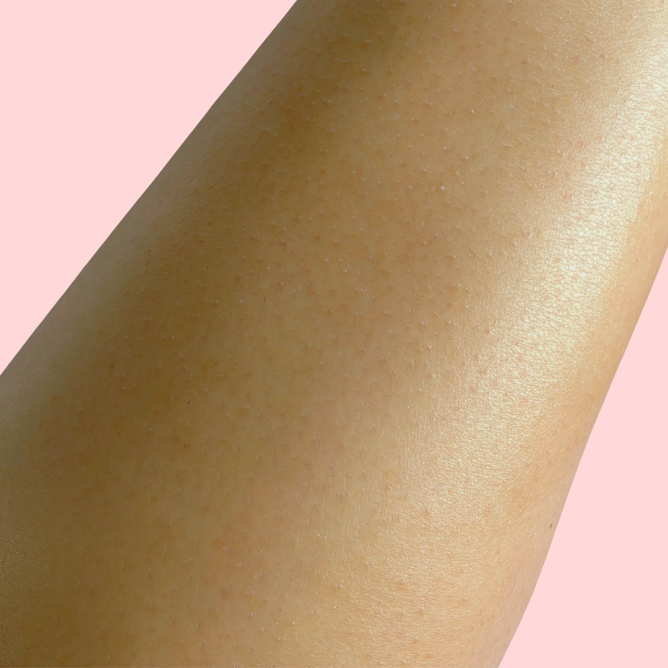 getting rid of strawberry legs