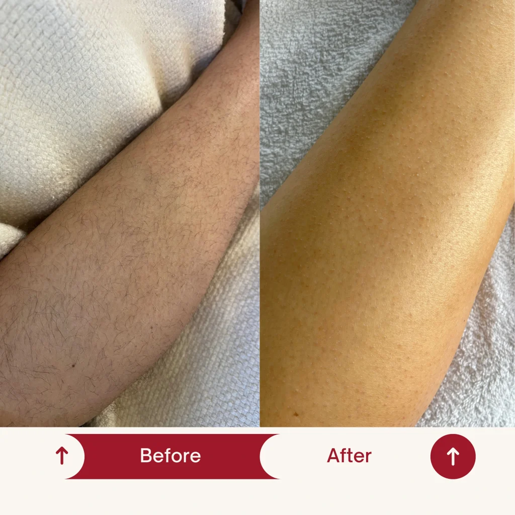 smooth skin preventing ingrown hair by skin replay women's safety razor